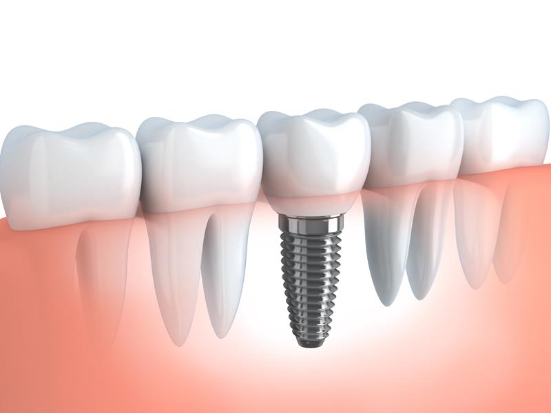 Dental Implants  Jerseyville, IL 