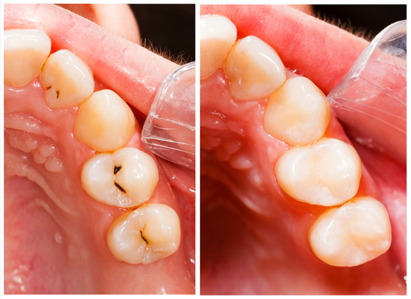 Fillings  Jerseyville, IL 