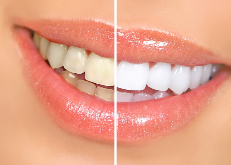 Teeth Whitening  Jerseyville, IL 