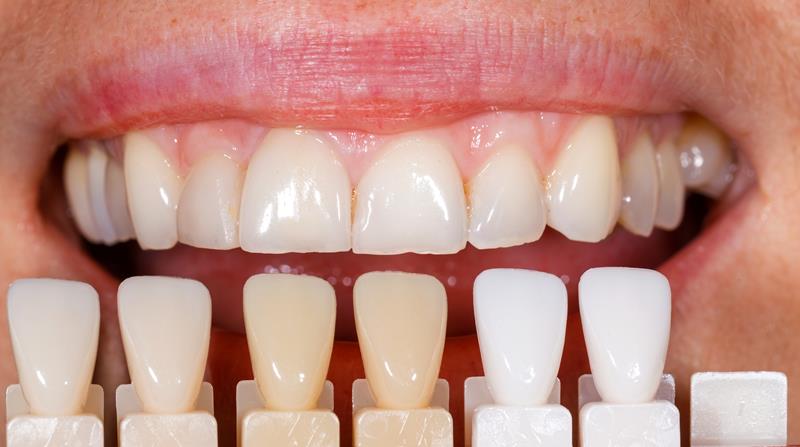Veneers  Jerseyville, IL 